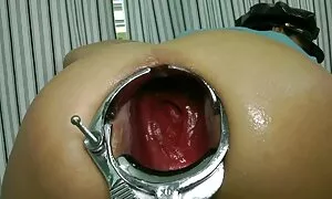 speculum prolapse hi ...